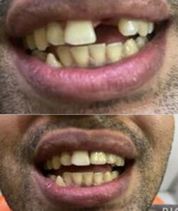 Dental Implants