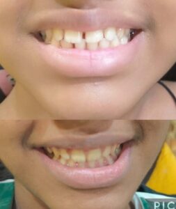 Invisible Aligners
