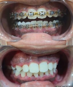 Orthodontic Treatment with Braces