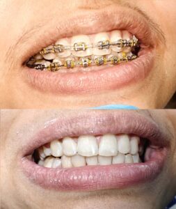 Orthodontic treatment for Alignment of Crooked teeth