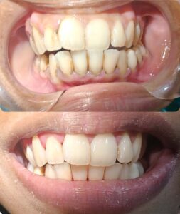 Scaling and polishing-1