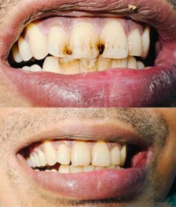 Scaling and polishing 2