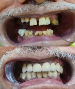 Smile designing-2