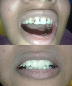Smile designing