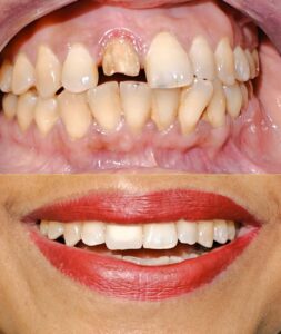 Smile designing-3