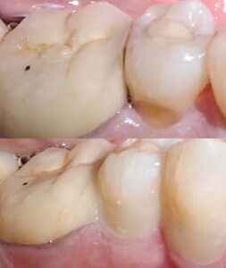 Tooth coloured filling